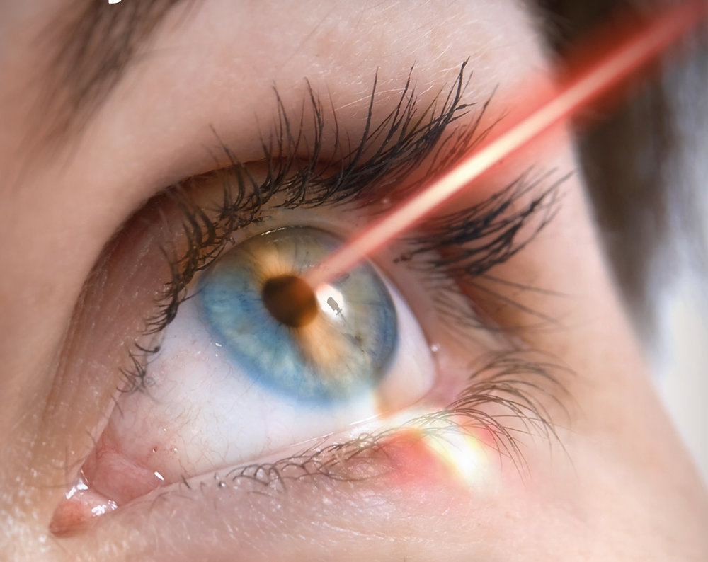 LASIK eye surgery