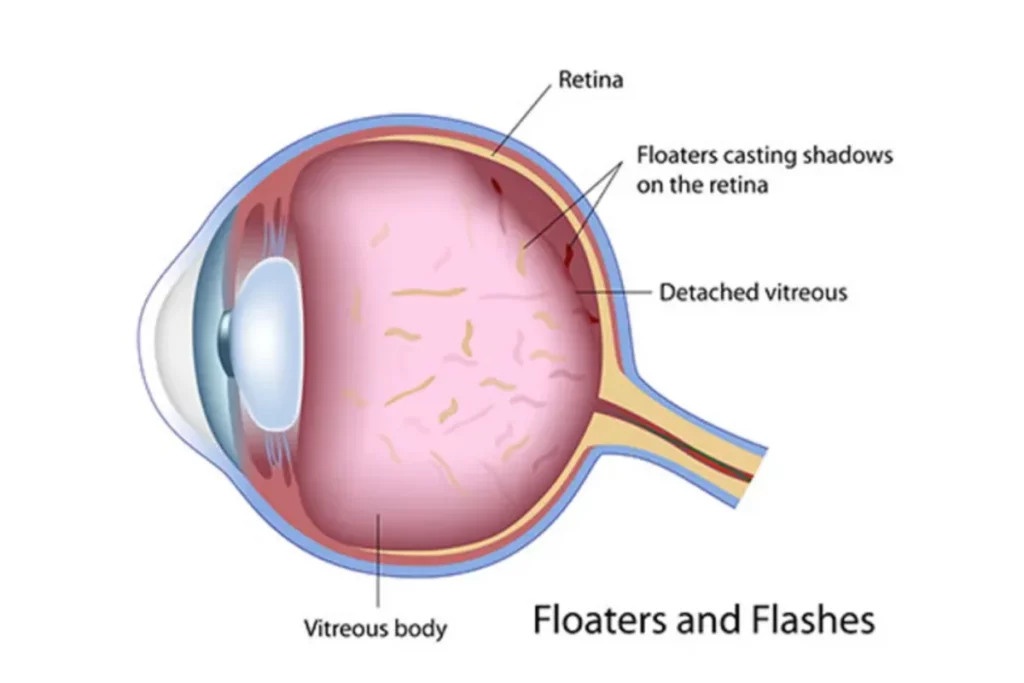 symptoms of retinal damage